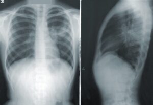 New Study Explains Why Lung Cancer Does Not Respond Favorably to Immunotherapy