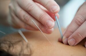 Needles of Healing: Unlocking the Timeless Power of Acupuncture for Cancer Patients