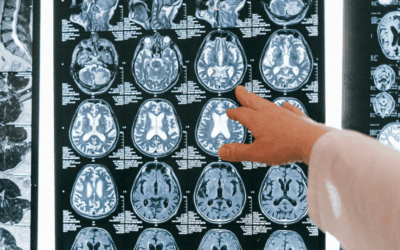 Guess Which Two Nutrients Decreased Deadly Glioblastoma in Recent Study?