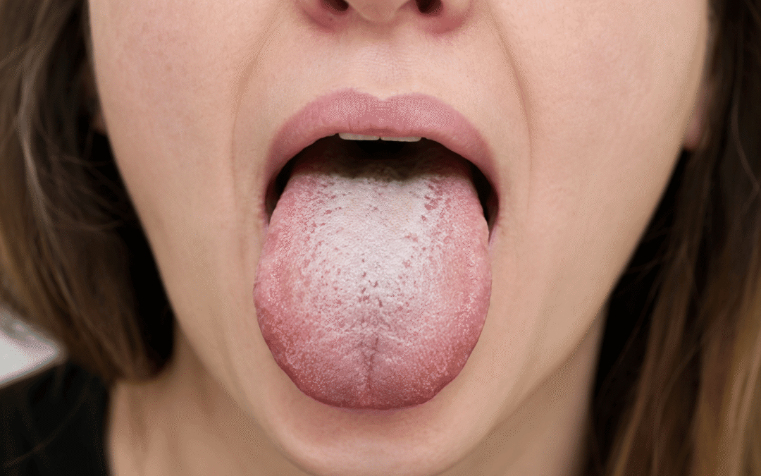 Candida: The Truth About the “Killer Yeast”