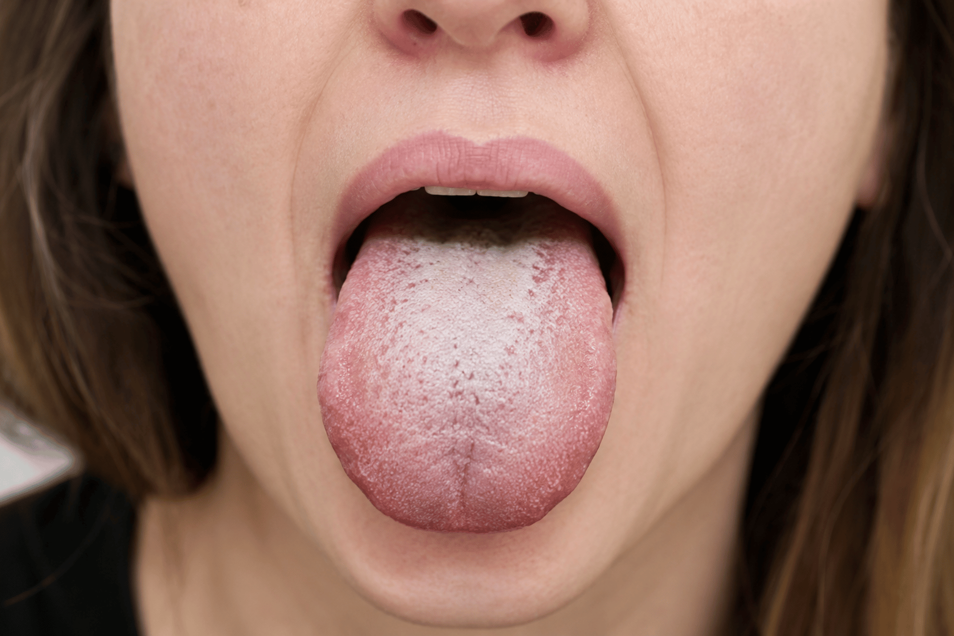 Candida: The Truth About the "Killer Yeast"