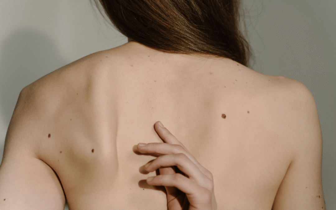 Raised Moles: When They’re Harmless—and When to Get Them Checked